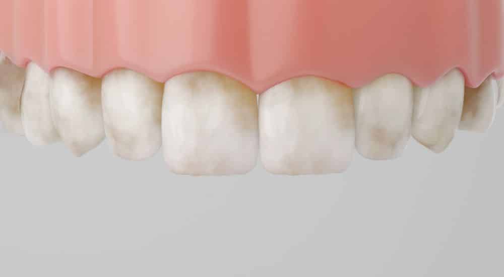 Fluorose dentaire : une pathologie évitable