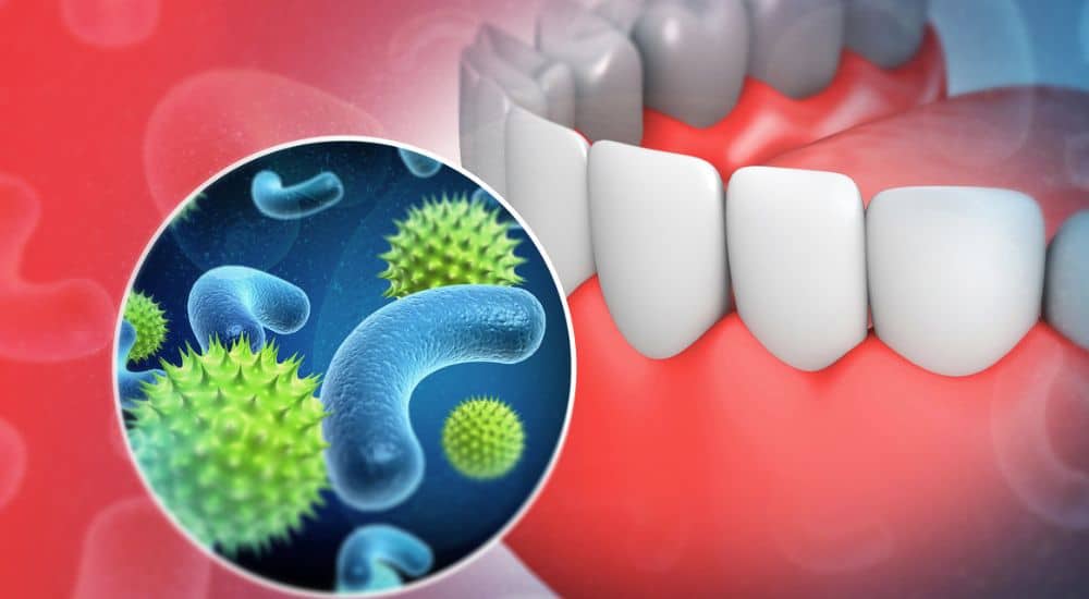 Dent humaine avec des bactéries et des virus microscopiques, germes, Prévention de la pneumonie nosocomiale