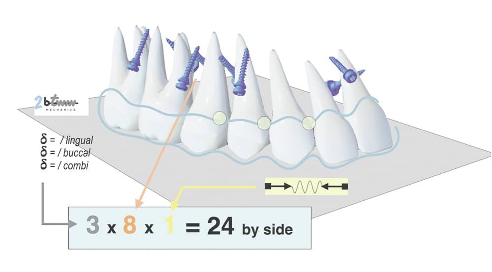 aligneurs et minivis d'ancrage