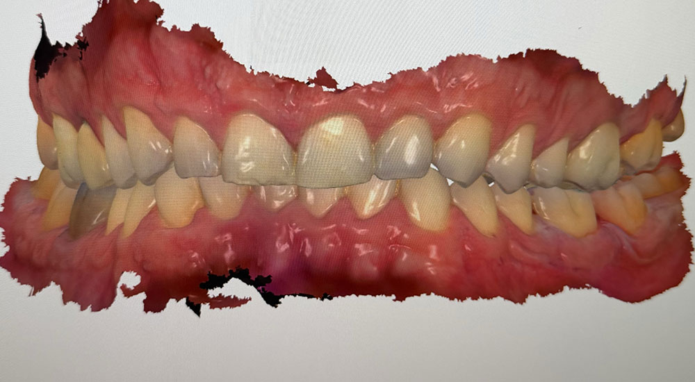 Validation d’une nouvelle dimension verticale d’occlusion par overlays imprimés en 3D : une approche numérique, réversible et minimalement invasive