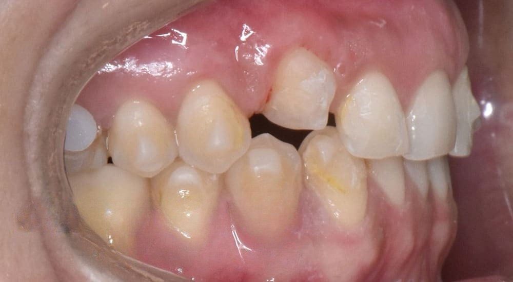 Retard d&rsquo;éruption et dents incluses