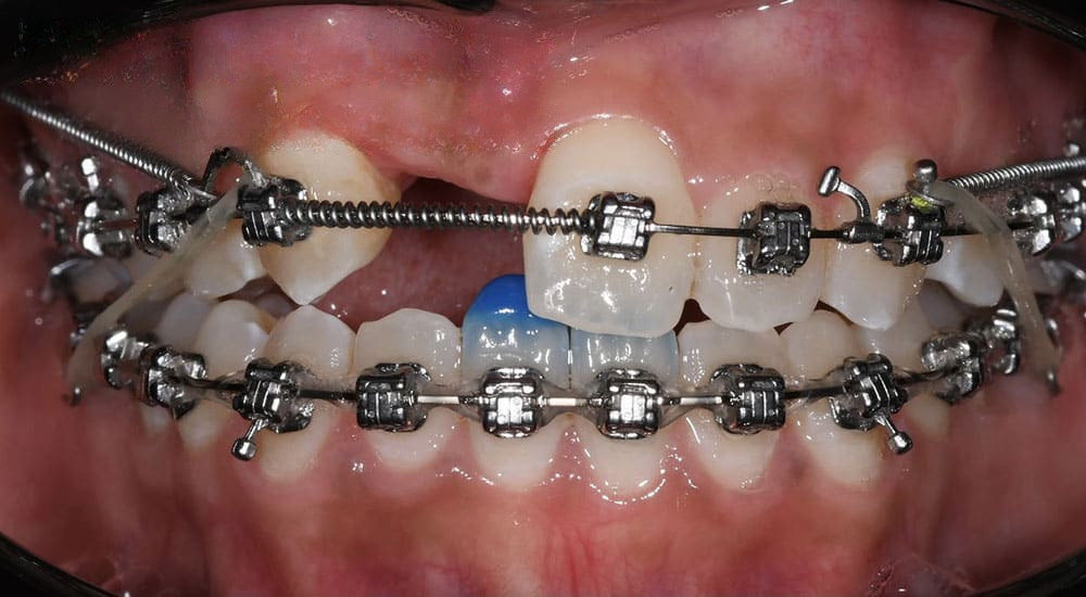 Traitement d’une malocclusion iatrogène sévère