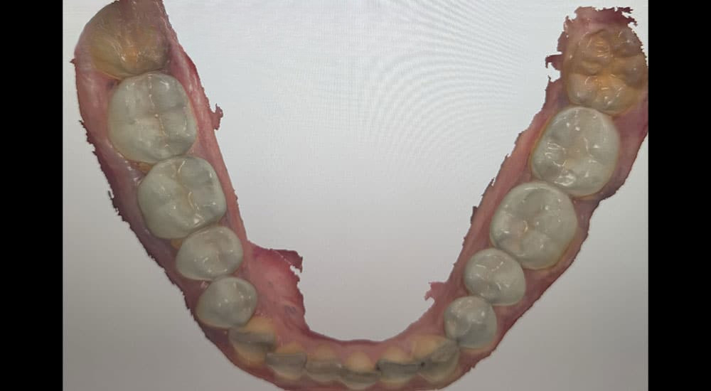 Validation d’une nouvelle dimension verticale d’occlusion par overlays imprimés en 3D