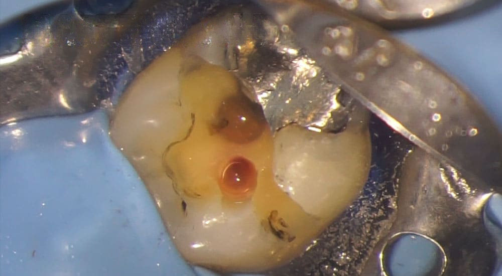 Résorption cervicale externe : traitement a minima