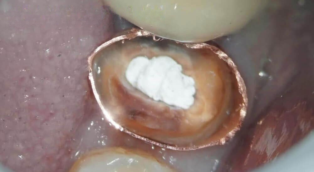 Retraitement endodontique orthograde d&rsquo;une prémolaire mandibulaire