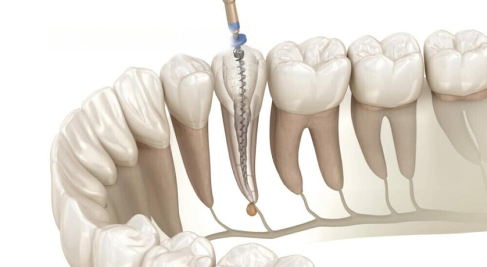 Endodontie : comment traiter les canaux courbes ou calcifiés ?