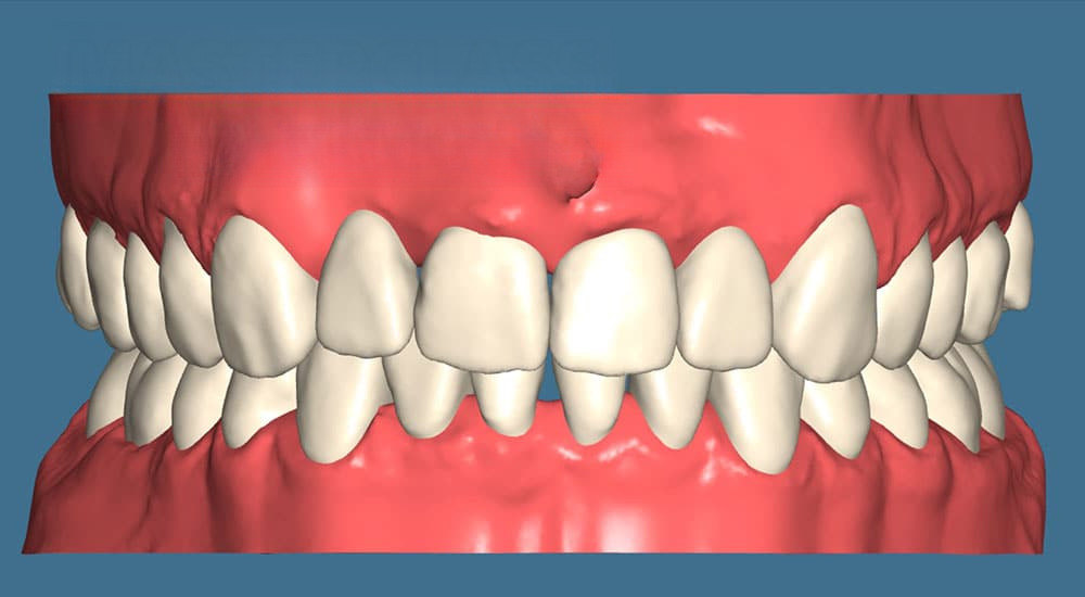 La fabrication d&rsquo;aligneurs au cabinet d&rsquo;orthodontie