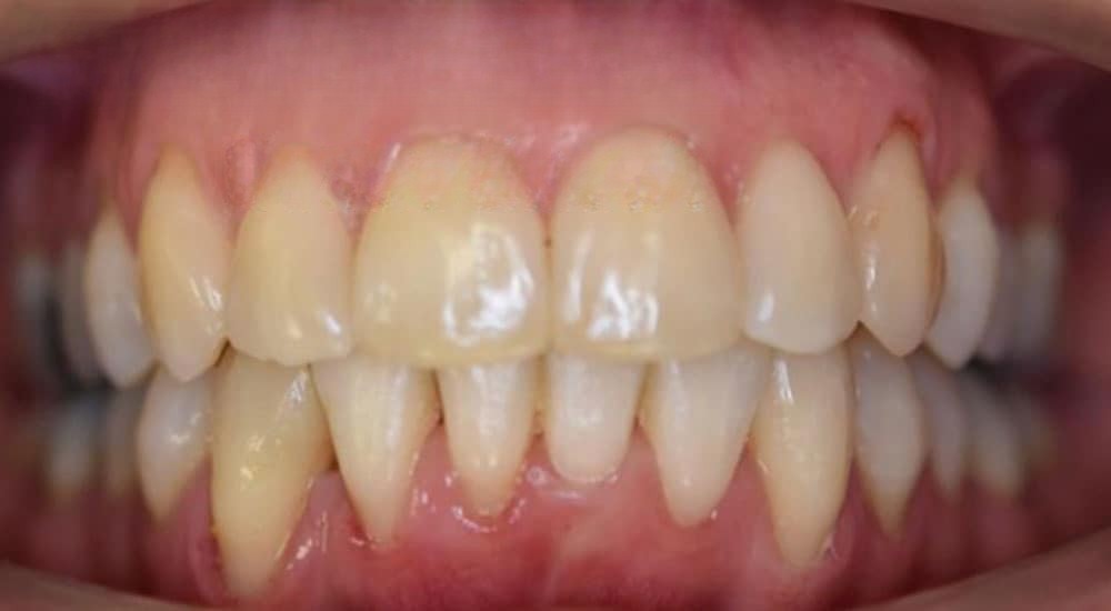 Contrôle des limites antérieures de la denture en thérapeutique par aligneurs avec minivis d&rsquo;ancrage