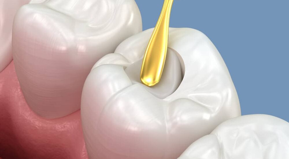 Les matériaux bioactifs en dentisterie restauratrice