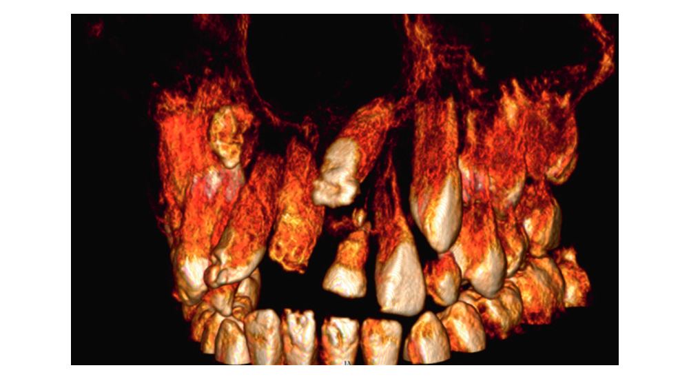 Incisive centrale maxillaire incluse : apport du CBCT et principes thérapeutiques