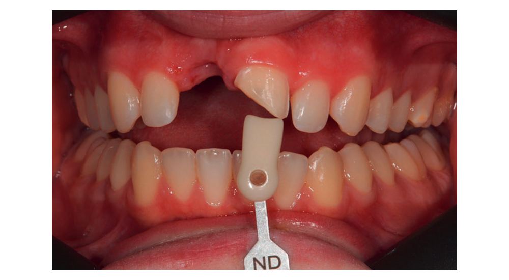 Reprise d’un traitement orthodontique après traumatisme dento-alvéolaire