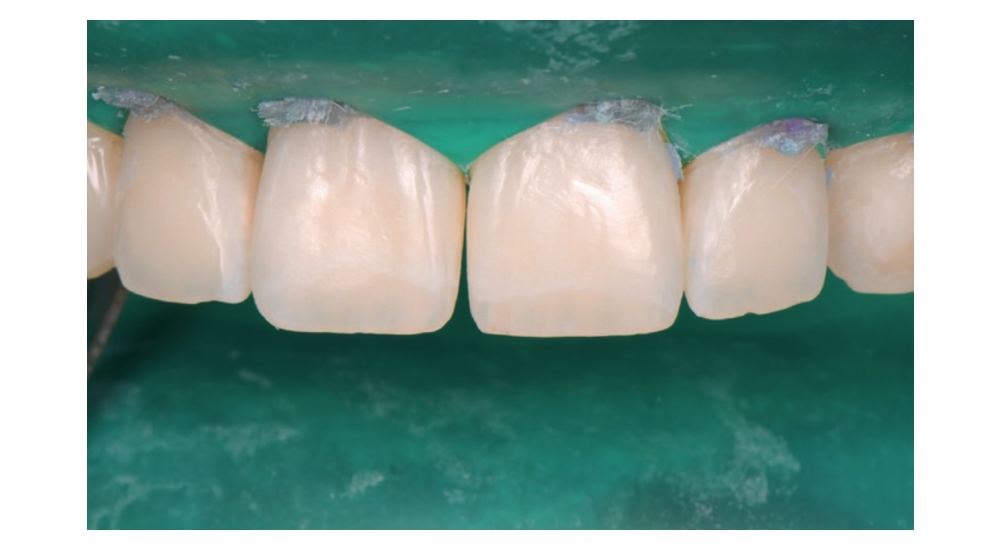 Masquage des white spot lesions post-orthodontiques : micro-abrasion et érosion-infiltration